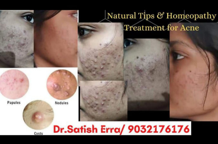 acne treatment in homeopathy hyderabad