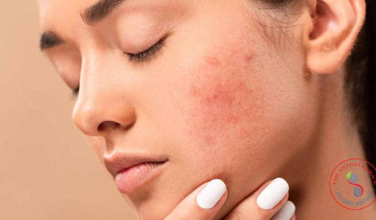 Can homeopathy cure acne and pimples?