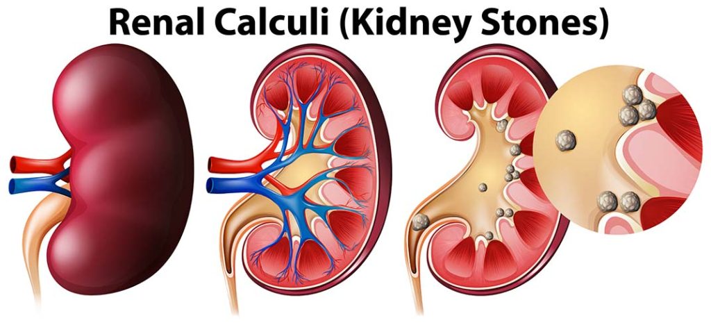 Best Homeopathic Treatment For Kidney Stone