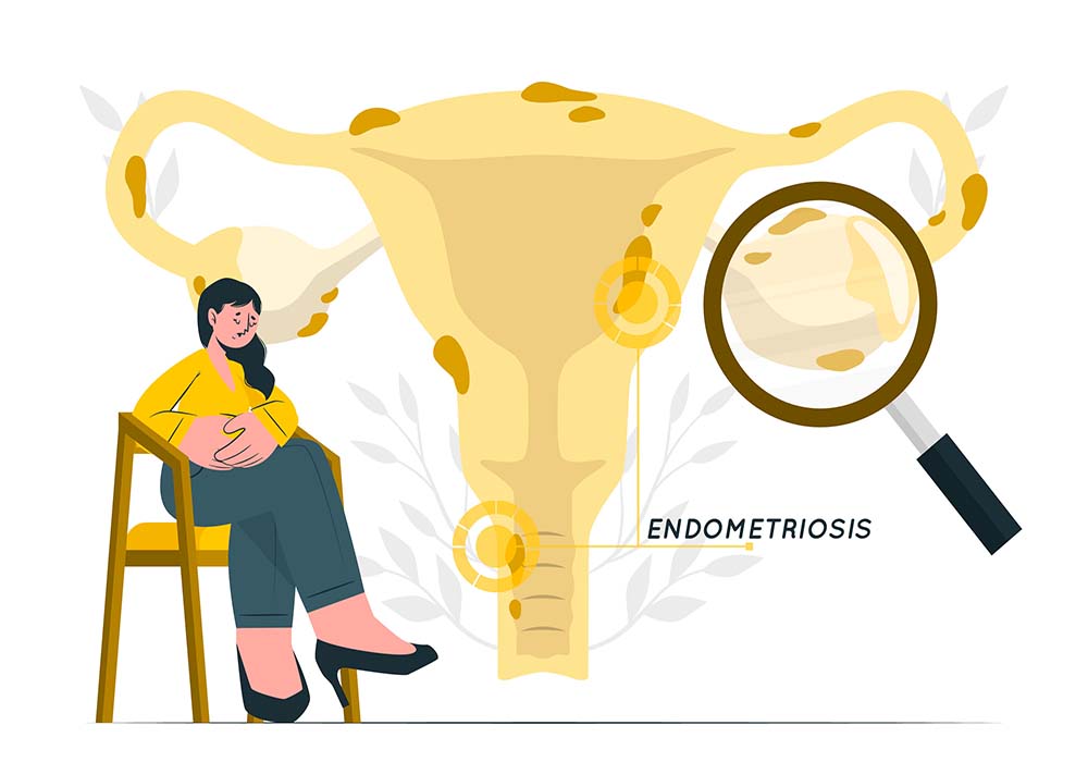 Homeopathic Treatment for Endometriosis