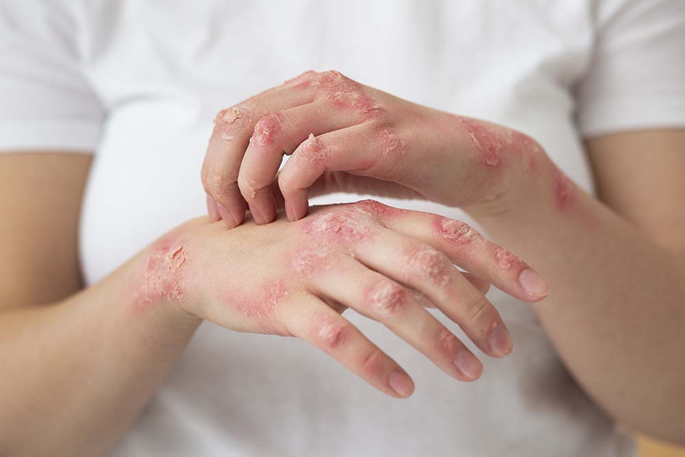 Homeopathic Psoriasis Treatment
