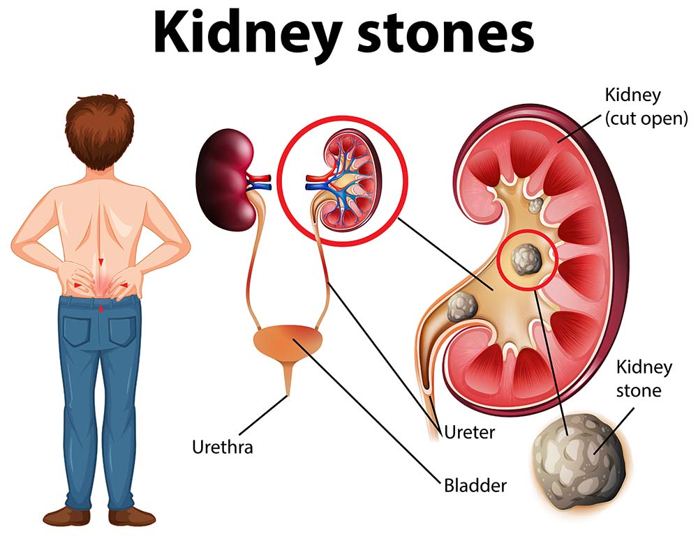 Homeopathy Kidney Stone Issues