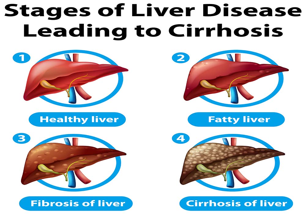 Homeopathic Treatment for Fatty Liver in Women