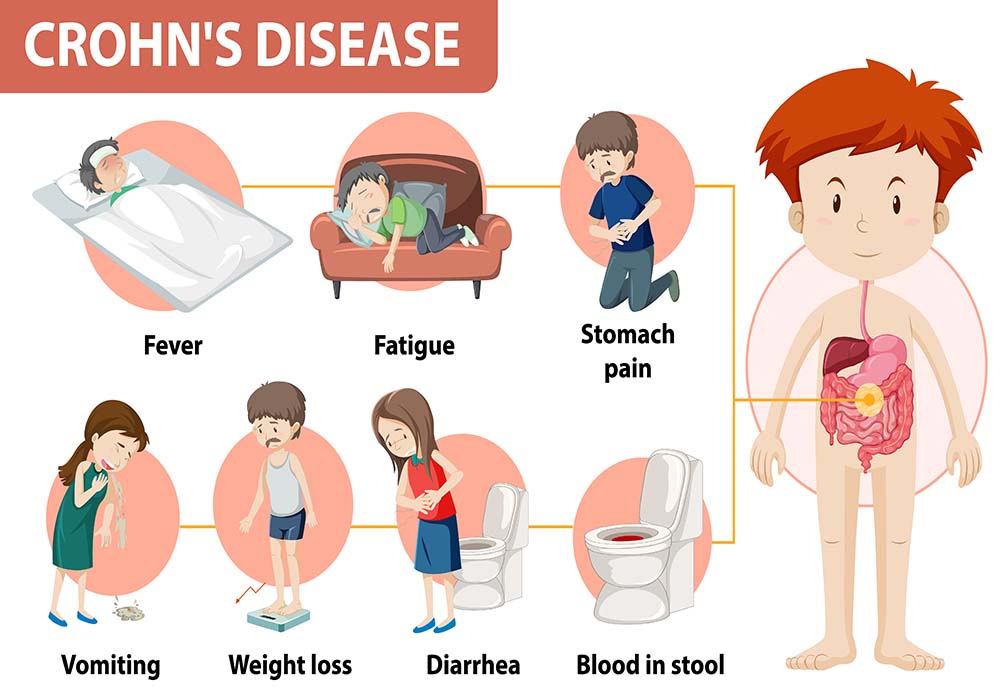 Crohn's Disease and Treatment in Homeopathy