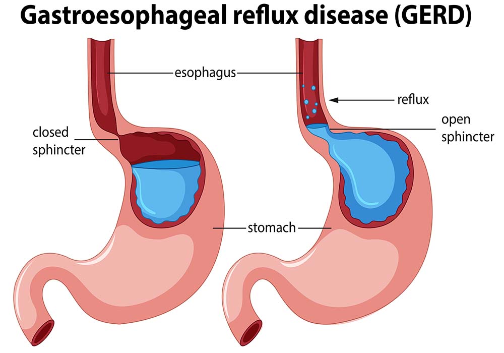 Effective Homeopathic Treatment for GERD