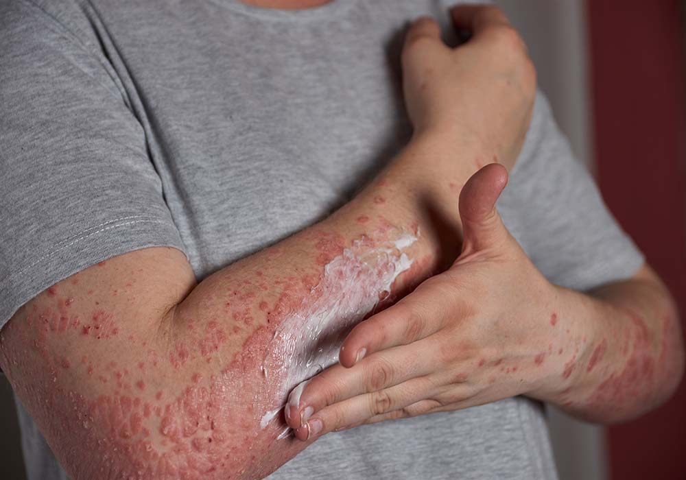 Homeopathic Treatment for Skin Rashes