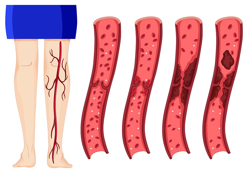 Best Homeopathic Treatment for Varicose Veins