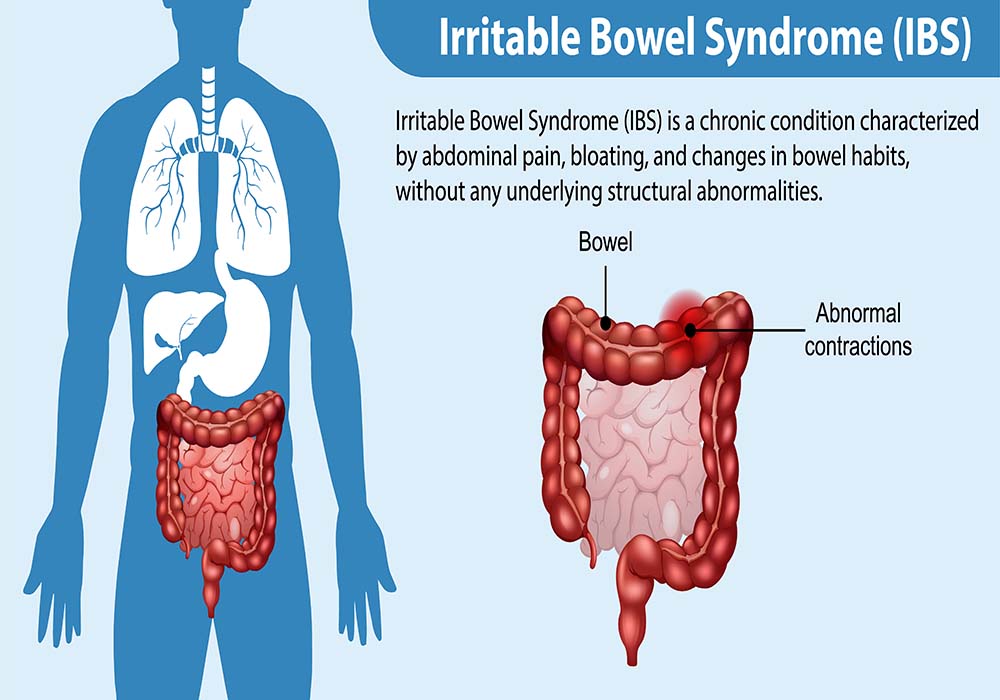 Homeopathy for a gentle and holistic approach to IBS treatment